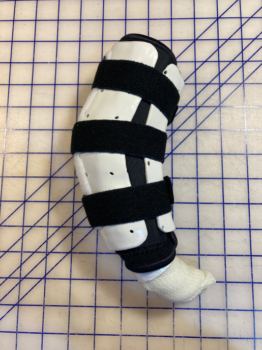 Tarsal Support with External Splint